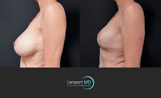 Breast Explant Before & After Gallery - Patient 203924 - Image 5