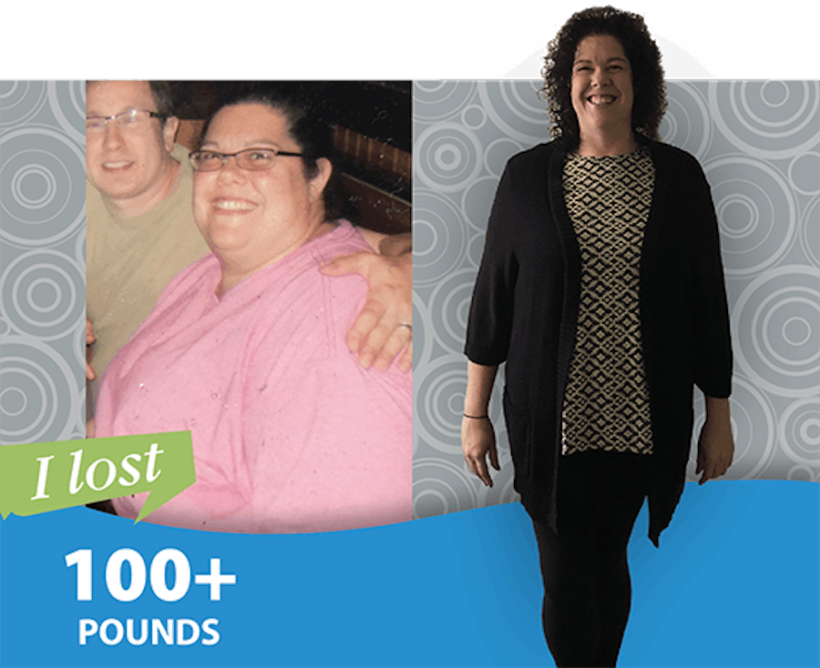 Female patient loses 100+ pounds before and after photo.