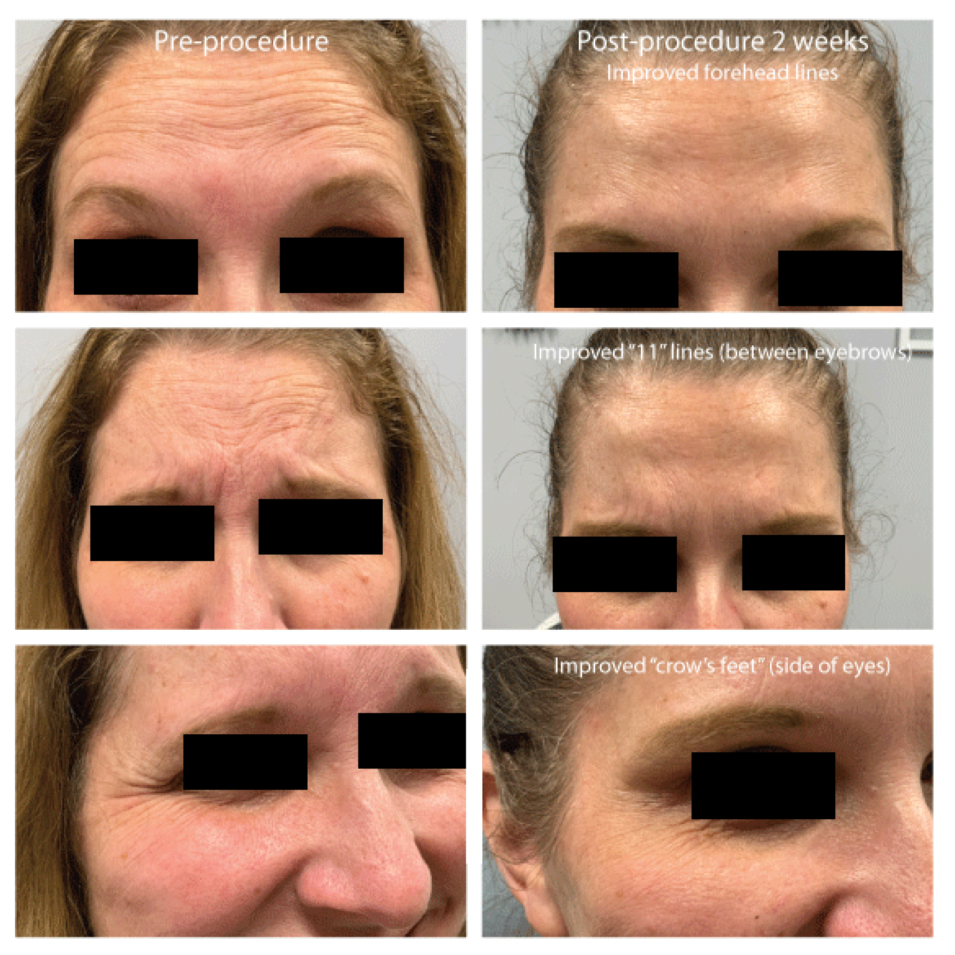 Six before and after photos of Botox in Upper East Side