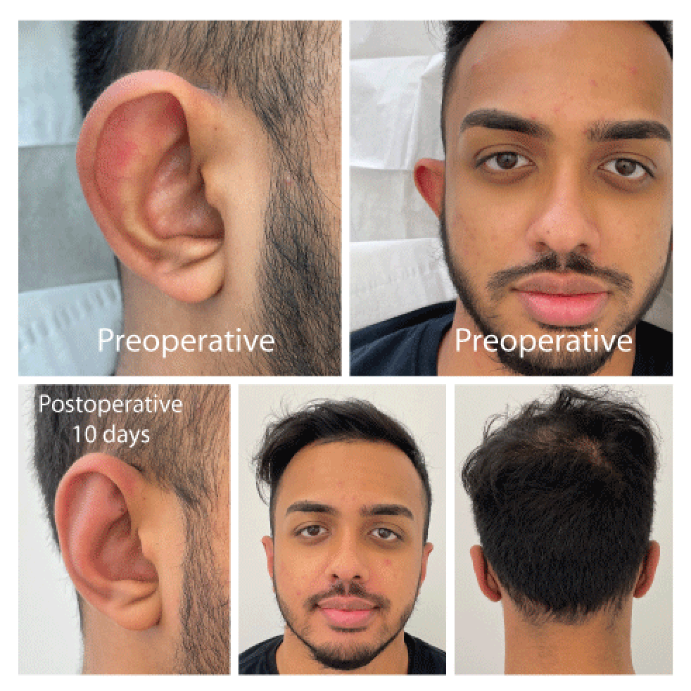 Otoplasty before and after