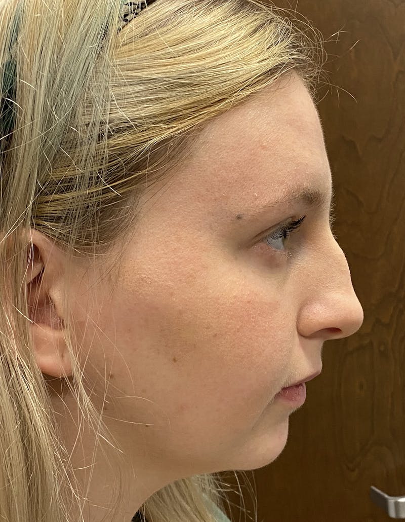 Rhinoplasty Before & After Gallery - Patient 87168871 - Image 1