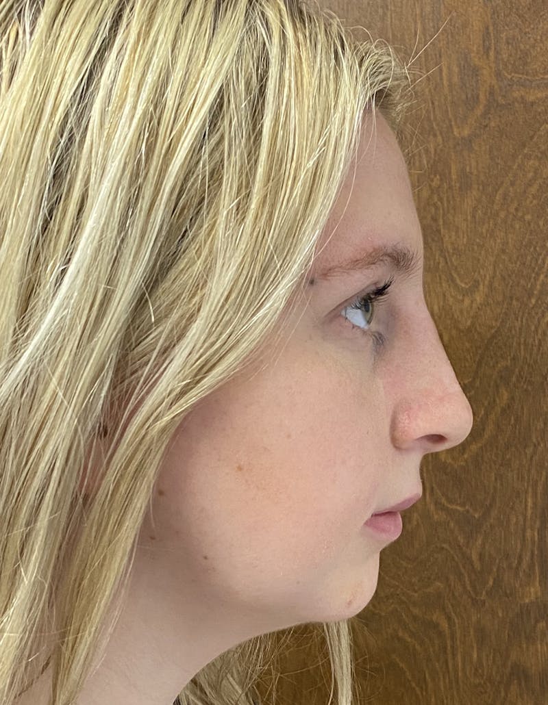 Rhinoplasty Before & After Gallery - Patient 87168871 - Image 2
