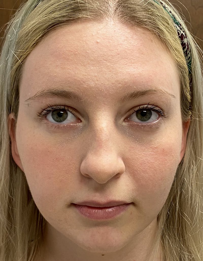 Rhinoplasty Before & After Gallery - Patient 87168871 - Image 3