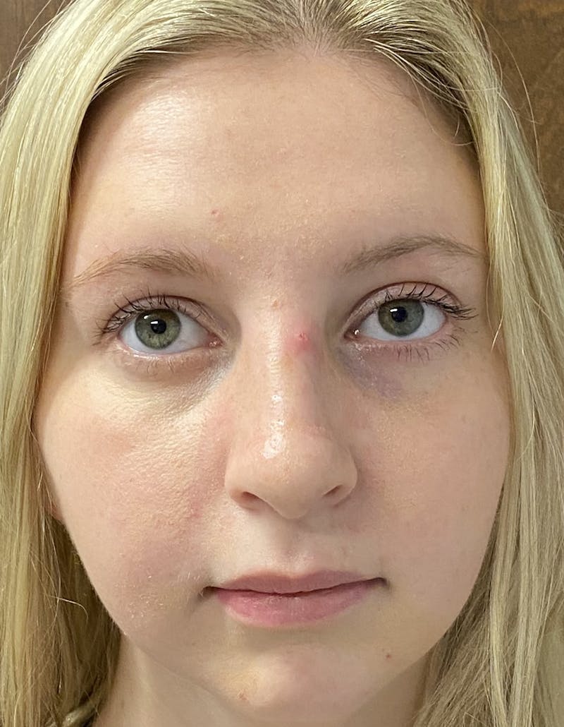 Rhinoplasty Before & After Gallery - Patient 87168871 - Image 4