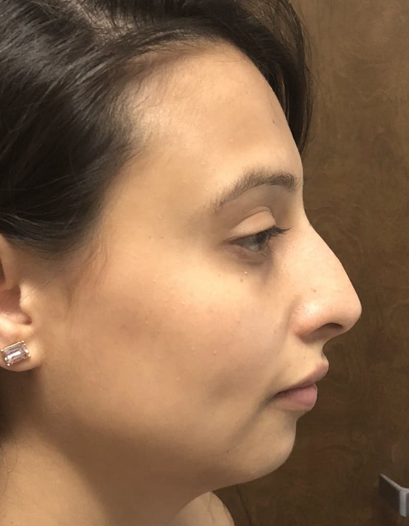 Rhinoplasty Before & After Gallery - Patient 87168870 - Image 1