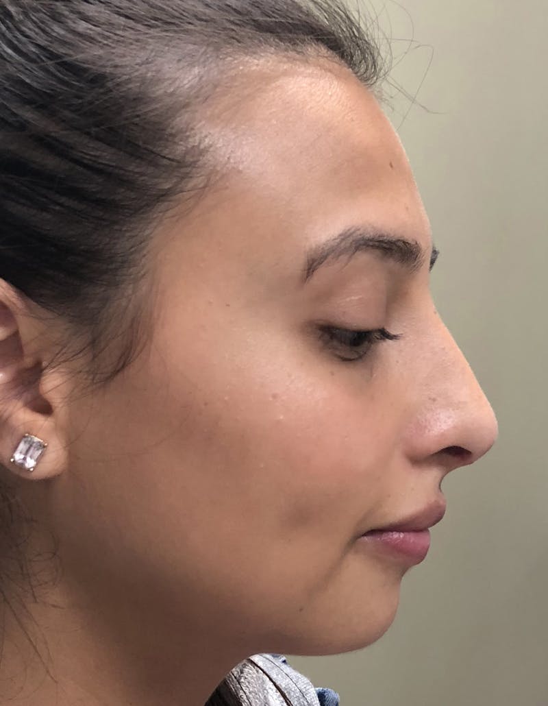 Rhinoplasty Before & After Gallery - Patient 87168870 - Image 2
