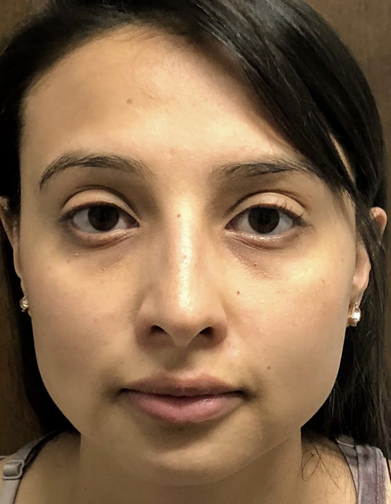 Rhinoplasty Before & After Gallery - Patient 87168870 - Image 3