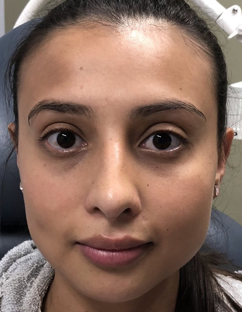 Rhinoplasty Before & After Gallery - Patient 87168870 - Image 4
