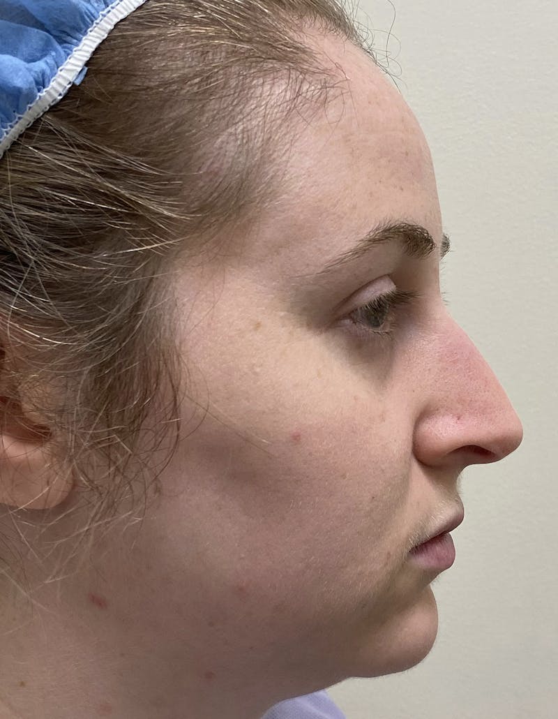 Rhinoplasty Before & After Gallery - Patient 87168868 - Image 1