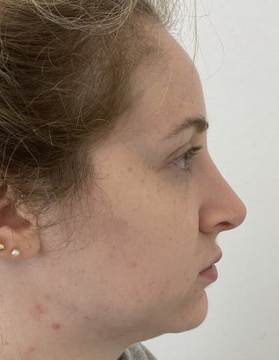 Rhinoplasty Before & After Gallery - Patient 87168868 - Image 2