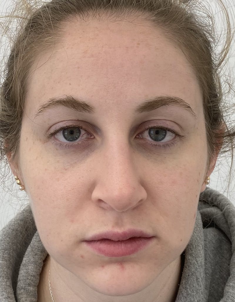 Rhinoplasty Before & After Gallery - Patient 87168868 - Image 4