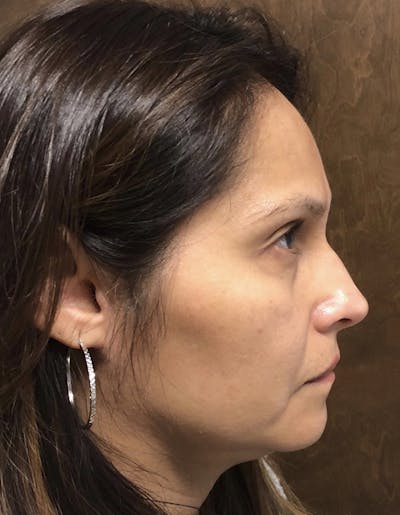 Rhinoplasty Before & After Gallery - Patient 87168872 - Image 1