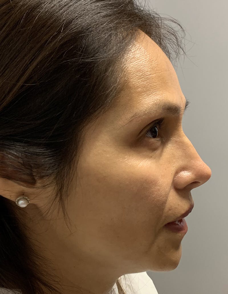Rhinoplasty Before & After Gallery - Patient 87168872 - Image 2