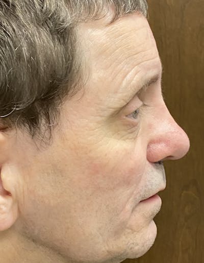 Rhinoplasty Before & After Gallery - Patient 87168867 - Image 2