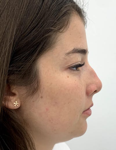 Rhinoplasty Before & After Gallery - Patient 87168866 - Image 1