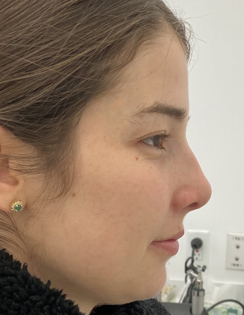 Rhinoplasty Before & After Gallery - Patient 87168866 - Image 2