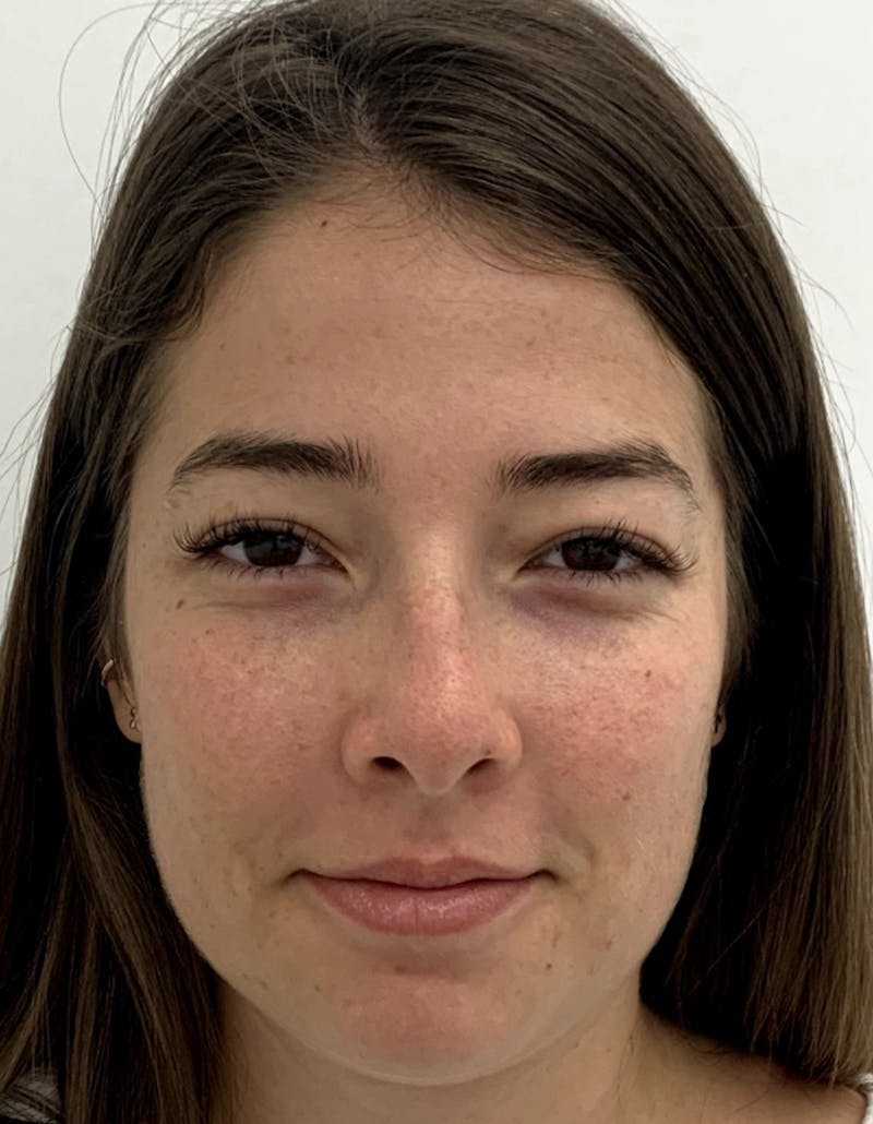 Rhinoplasty Before & After Gallery - Patient 87168866 - Image 3