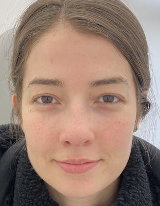 Rhinoplasty Before & After Gallery - Patient 87168866 - Image 4