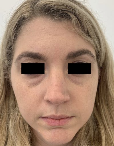 Rhinoplasty Before & After Gallery - Patient 87168869 - Image 1