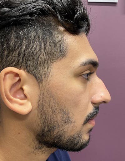 Rhinoplasty Before & After Gallery - Patient 87168865 - Image 1