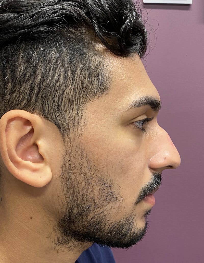 Rhinoplasty Before & After Gallery - Patient 87168865 - Image 1