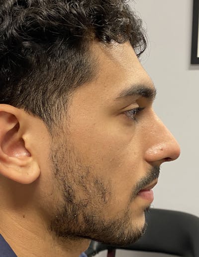 Rhinoplasty Before & After Gallery - Patient 87168865 - Image 2
