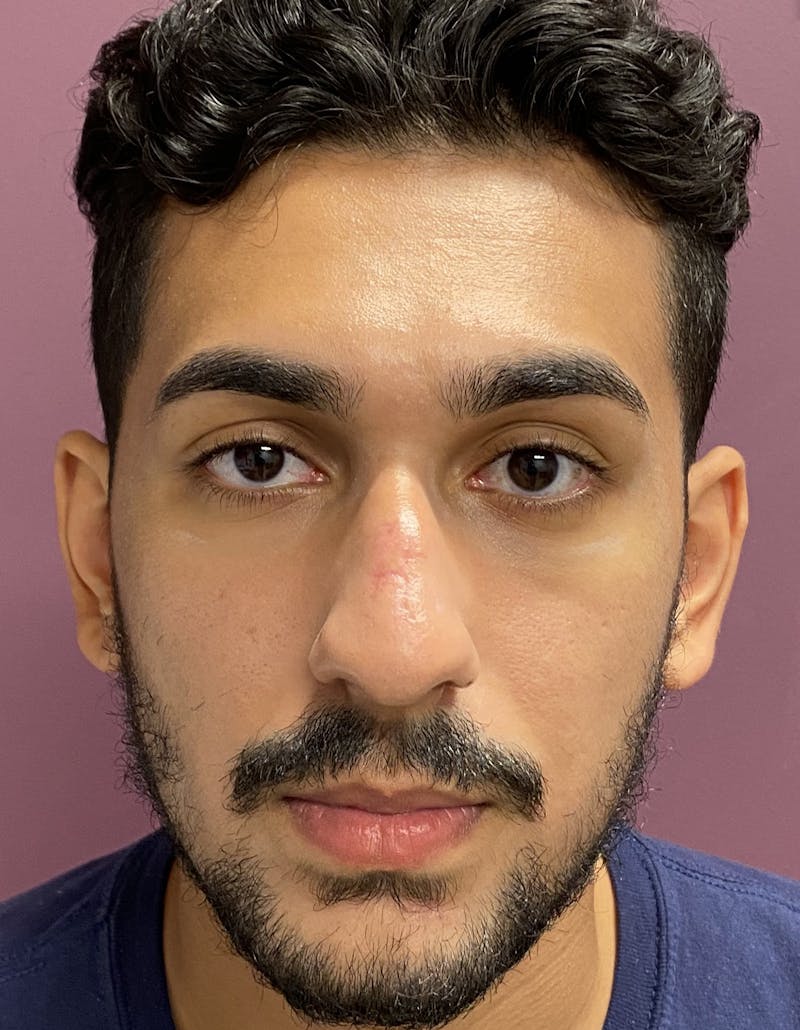 Rhinoplasty Before & After Gallery - Patient 87168865 - Image 3