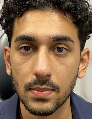 Rhinoplasty Before & After Gallery - Patient 87168865 - Image 4