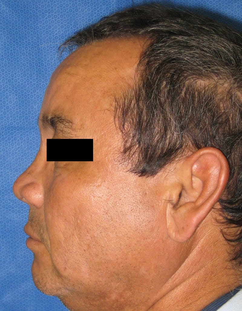 Rhinoplasty Before & After Gallery - Patient 87168864 - Image 3