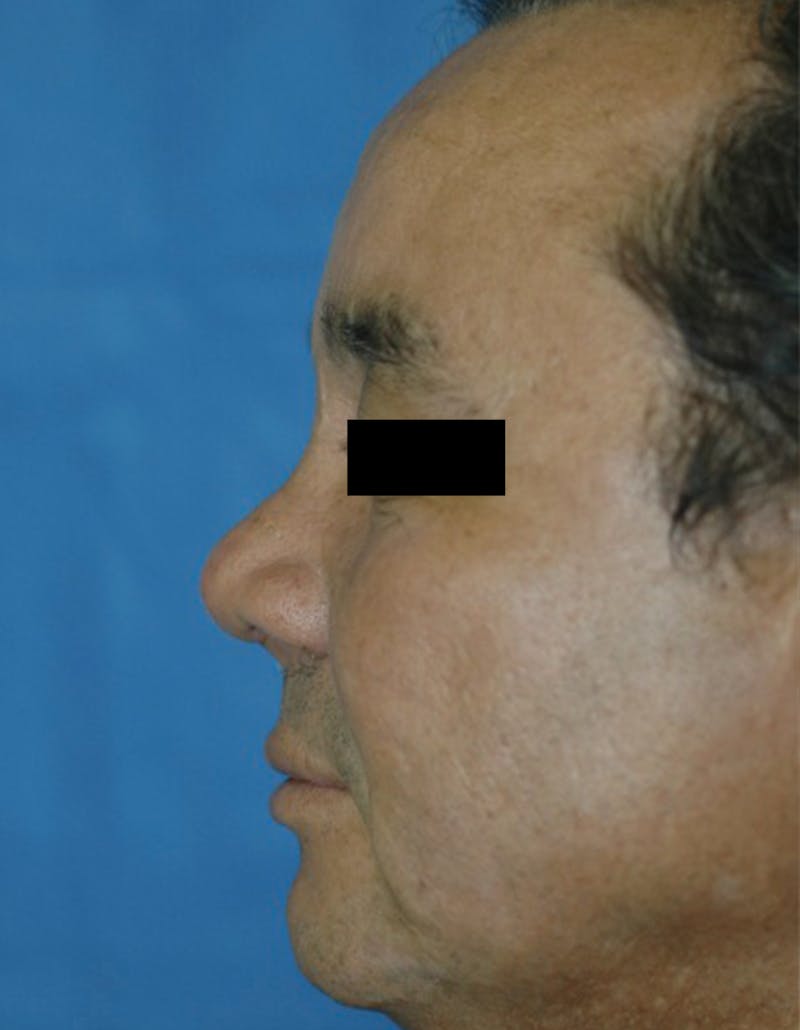 Rhinoplasty Before & After Gallery - Patient 87168864 - Image 4