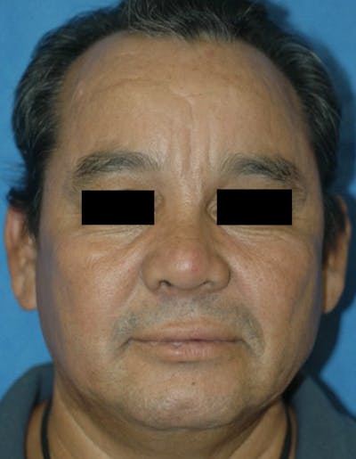 Rhinoplasty Before & After Gallery - Patient 87168864 - Image 2