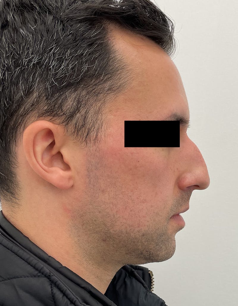 Rhinoplasty Before & After Gallery - Patient 87168863 - Image 1
