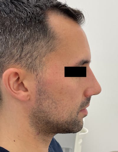 Rhinoplasty Before & After Gallery - Patient 87168863 - Image 2