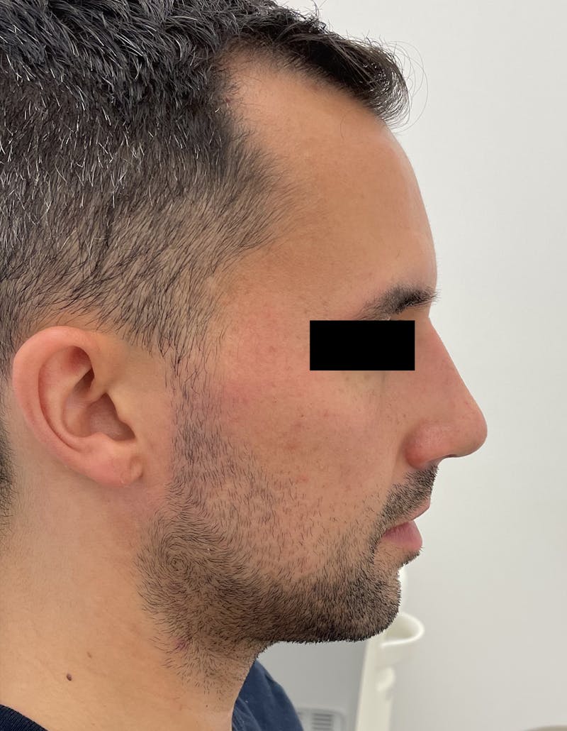 Rhinoplasty Before & After Gallery - Patient 87168863 - Image 2