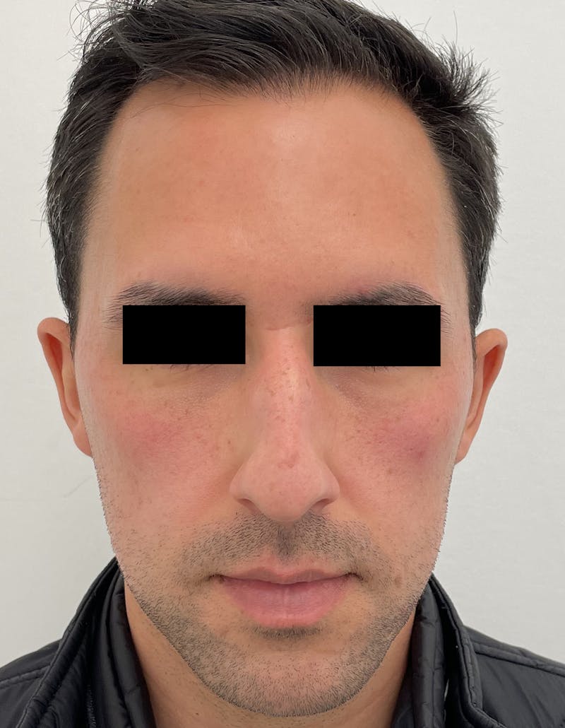 Rhinoplasty Before & After Gallery - Patient 87168863 - Image 3