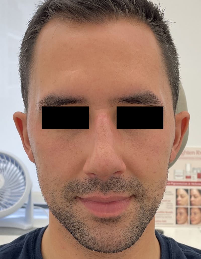 Rhinoplasty Before & After Gallery - Patient 87168863 - Image 4
