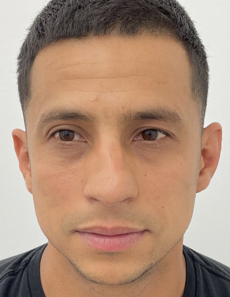 Rhinoplasty Before & After Gallery - Patient 91459326 - Image 1