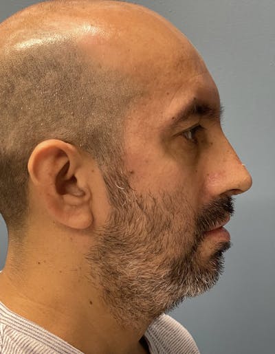 Rhinoplasty Before & After Gallery - Patient 91459327 - Image 2