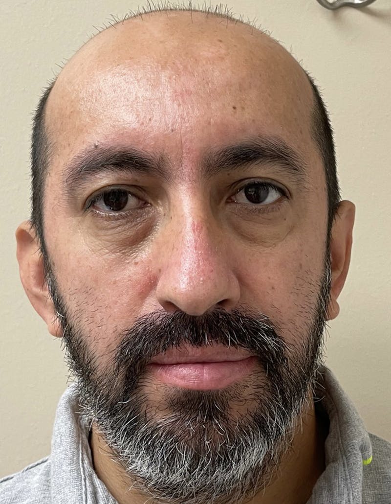 Rhinoplasty Before & After Gallery - Patient 91459327 - Image 3