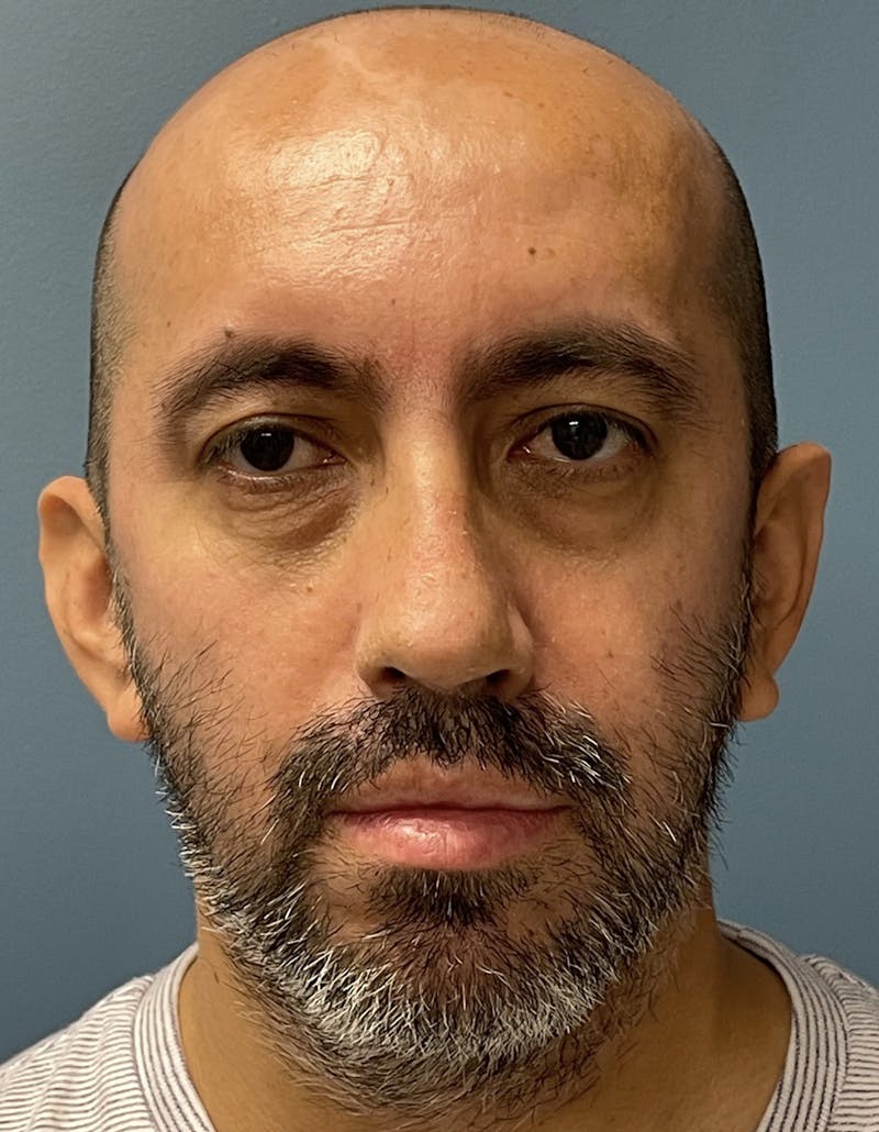 Rhinoplasty Before & After Gallery - Patient 91459327 - Image 4