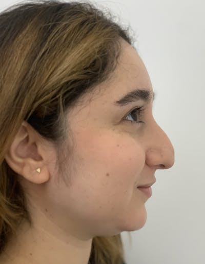 Rhinoplasty Before & After Gallery - Patient 91459328 - Image 1