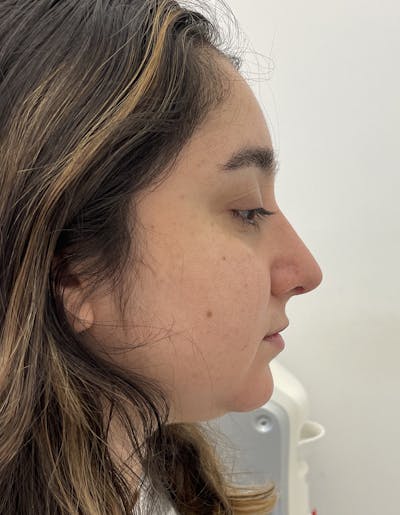 Rhinoplasty Before & After Gallery - Patient 91459328 - Image 2