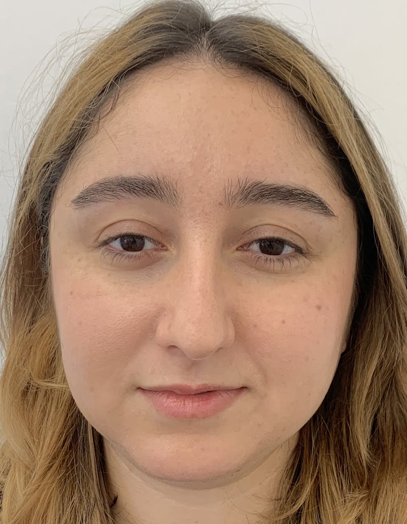 Rhinoplasty Before & After Gallery - Patient 91459328 - Image 3