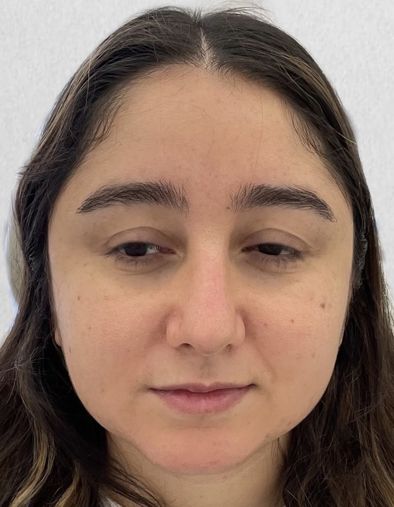 Rhinoplasty Before & After Gallery - Patient 91459328 - Image 4