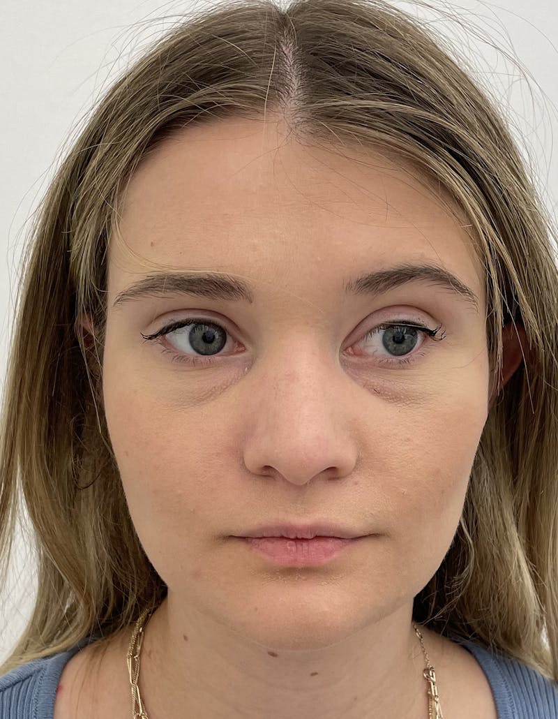 Rhinoplasty Before & After Gallery - Patient 91459341 - Image 3
