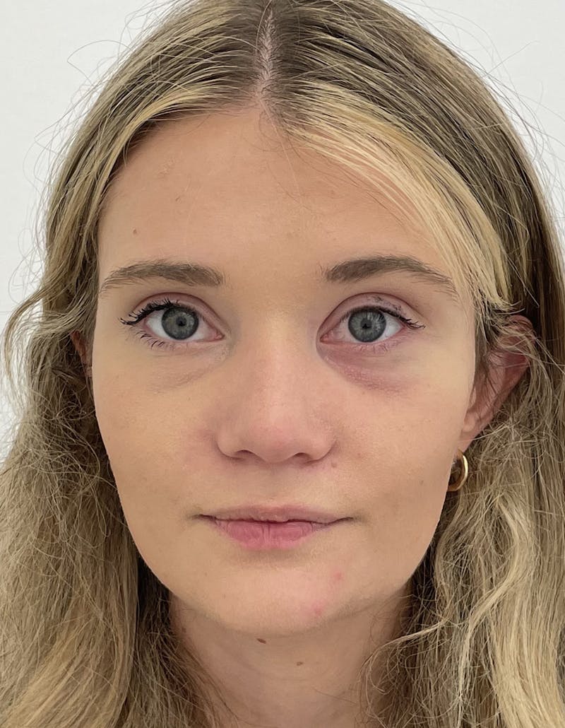 Rhinoplasty Before & After Gallery - Patient 91459341 - Image 4