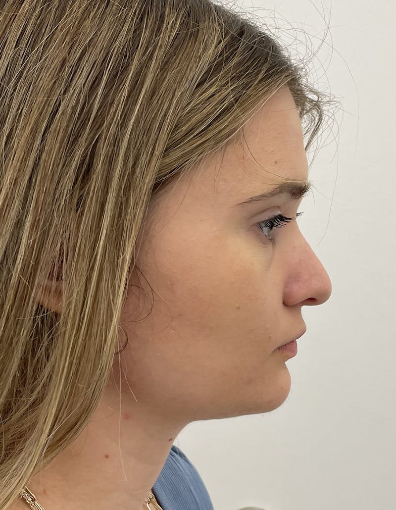 Rhinoplasty Before & After Gallery - Patient 91459341 - Image 1
