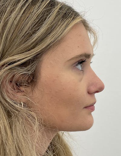 Rhinoplasty Before & After Gallery - Patient 91459341 - Image 2