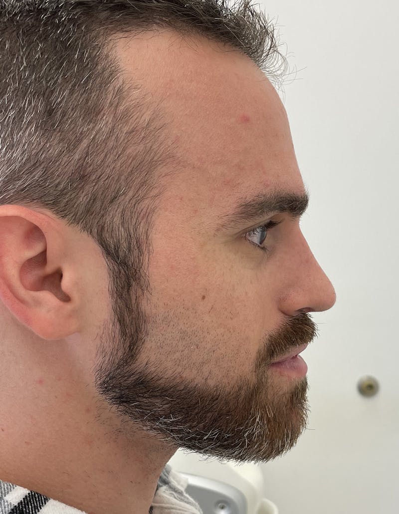 Rhinoplasty Before & After Gallery - Patient 91459346 - Image 4