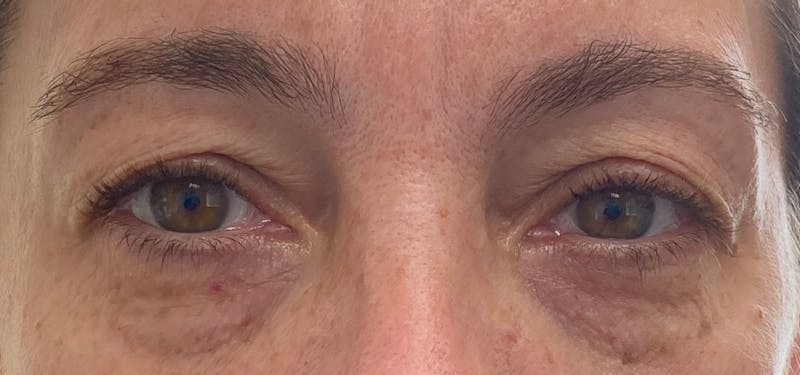 Blepharoplasty in Upper East Side patient 1